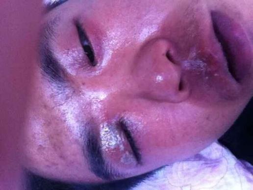 眼睛肿了轻微腐烂,救命啊,感觉要瞎了,去