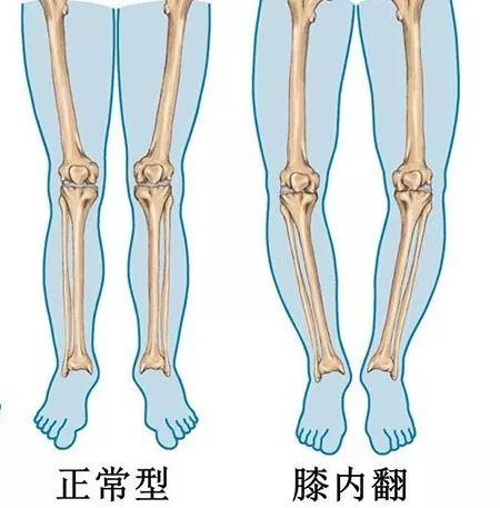 膝盖不适?"o型腿"?重视起来!别发展成骨关节炎才后悔