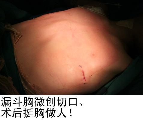 我院开设漏斗胸鸡胸专病门诊以来,为很多漏斗胸鸡胸的病友解除了烦恼
