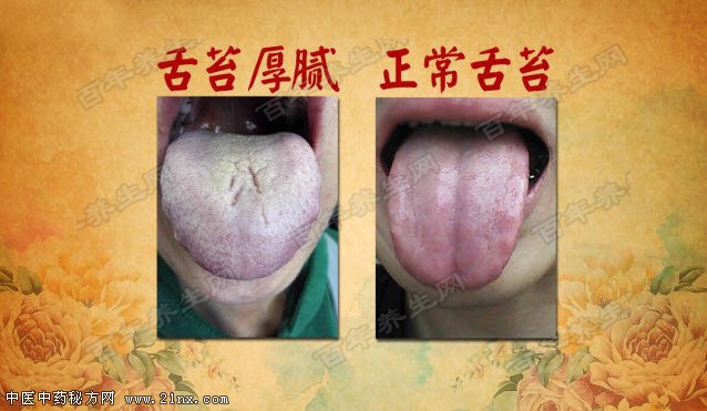 小舌头写有大信息:中医舌苔的质地讲究这么多!
