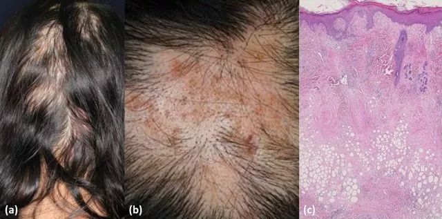 系统性红斑狼疮患者为什么会出现脱发?