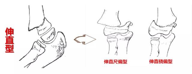 儿童最常见的骨折原来是:肱骨髁上骨折,怎样最容易受伤?