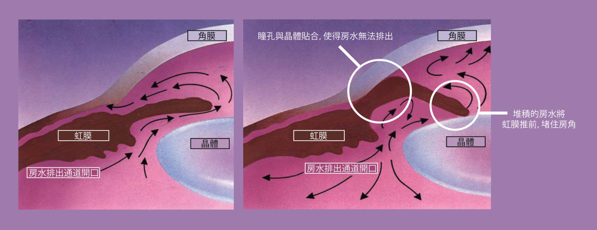 如何实时治疗急性青光眼?