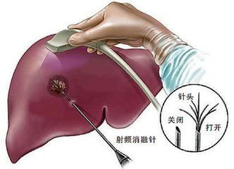 肠癌肝转移不等于绝症