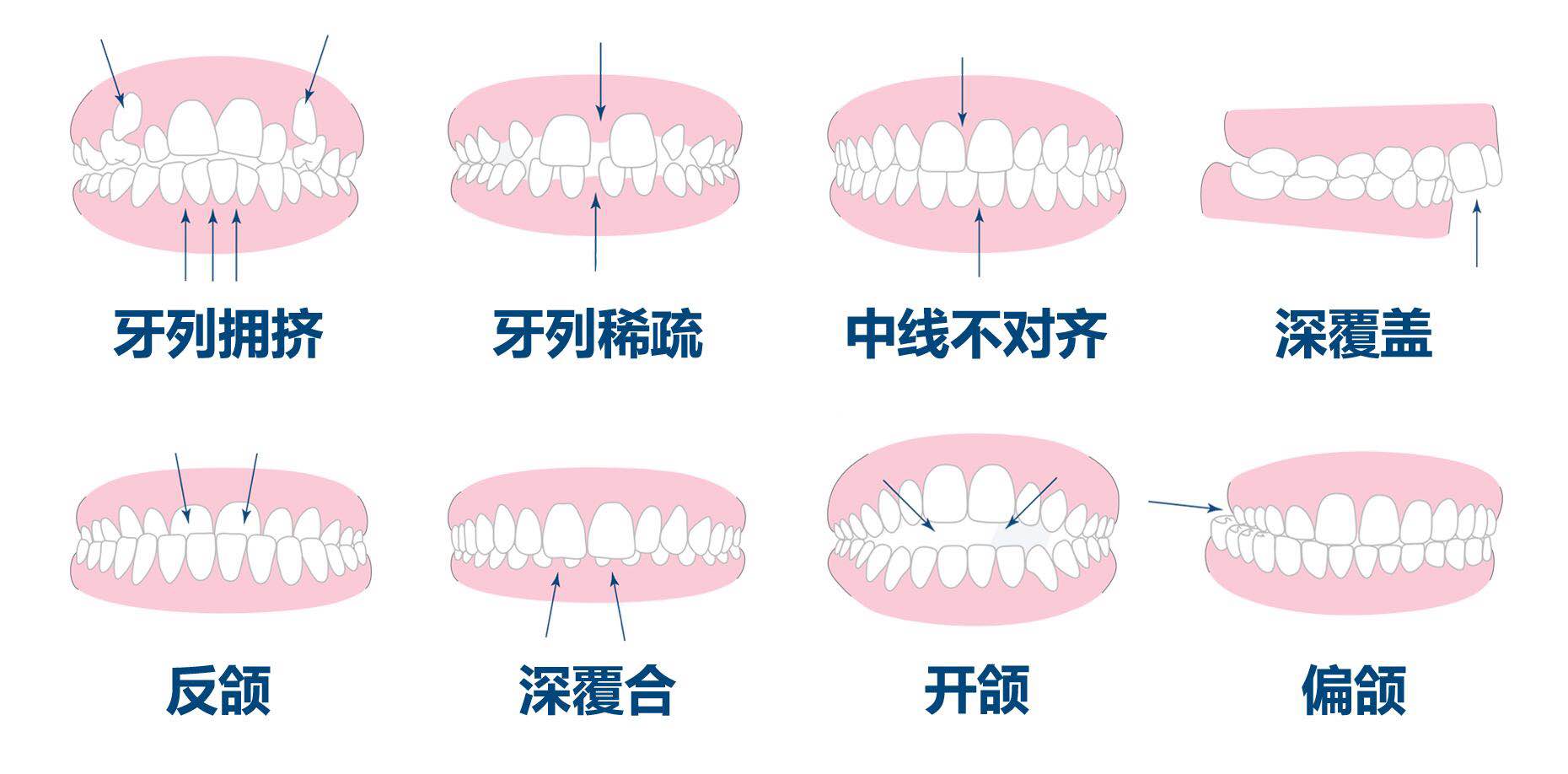 各类错合畸形可影响容貌外观,致使面部呈现 开唇露齿,双颌前突,长面