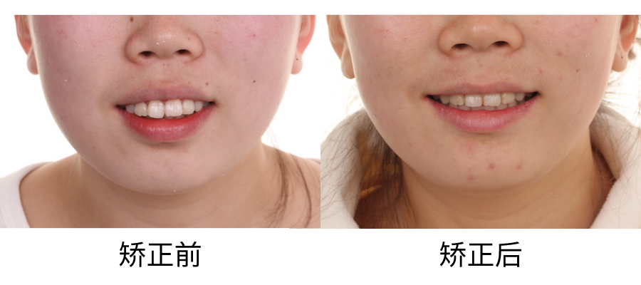25岁女骨性嘴凸下巴后缩,单纯矫正牙齿改善