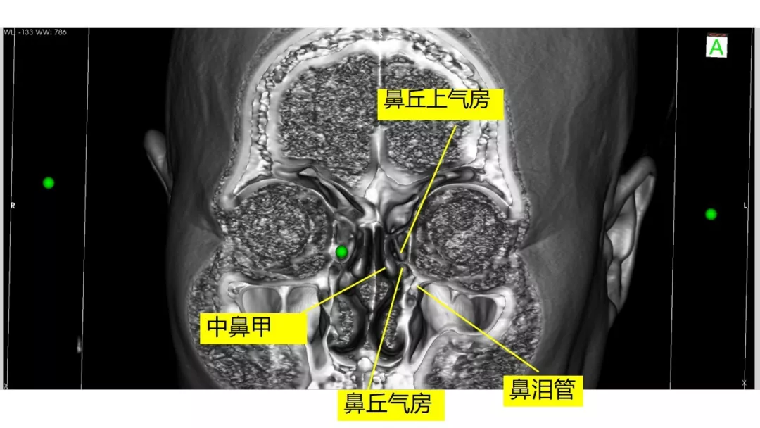 赵天智副教授前床突磨除与脑脊液漏处理中鼻道经筛入路