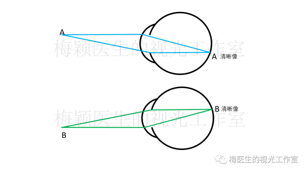 图4 近视眼a,b两像点都成像在视网膜前,是模糊的同样
