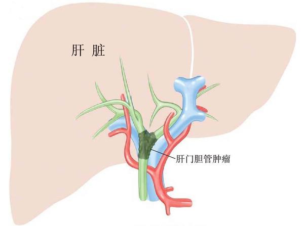 有哪些疾病需要使用ercp治疗?