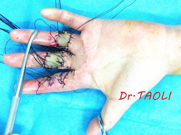 (患儿左手伤口的疤痕明显影响手指的伸直活动,给予疤痕松解后,植皮