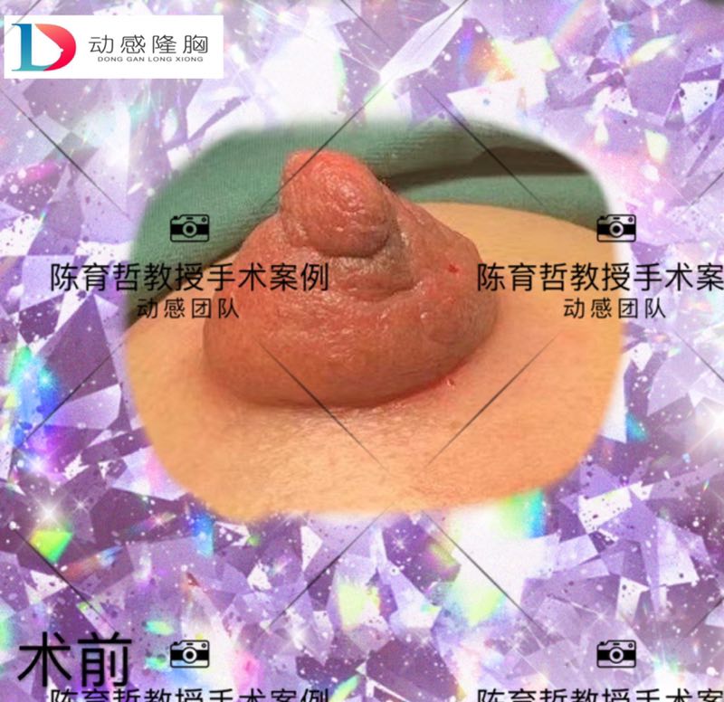 设计手术方案,切除多余膨出乳晕,环形缩小收紧乳晕.