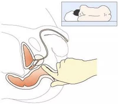 2.直肠指检