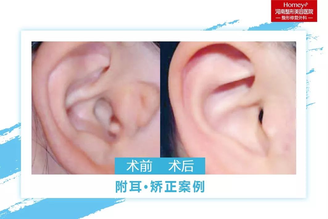 什么是附耳?