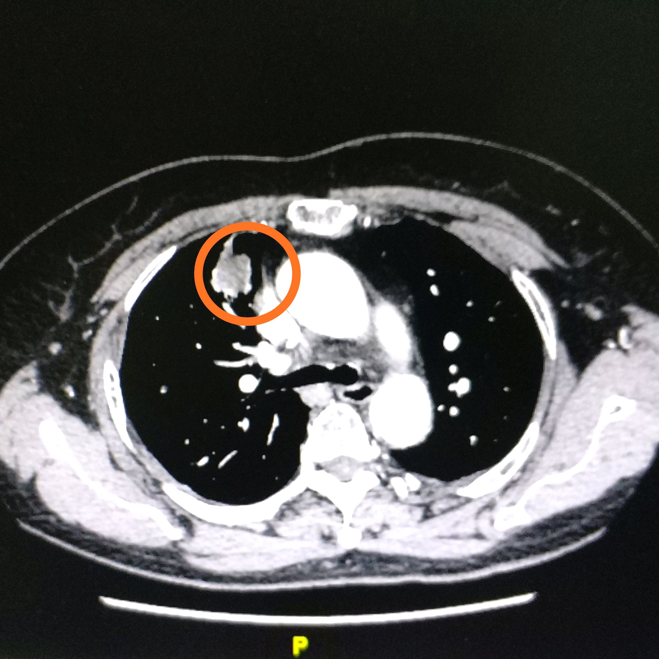 肿瘤标记物虽然是正常的,但是咳嗽原因不明,ct却发现肺上长了肿物.