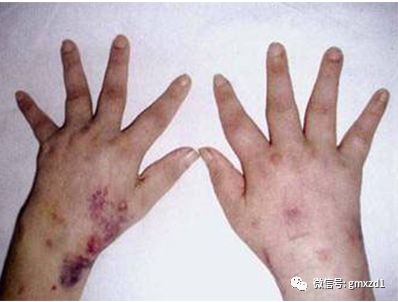 带图鉴别:与过敏性紫癜症状很相似的"皮肤表现"