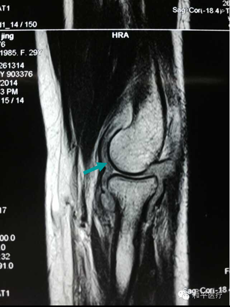 图二磁共振(mr)检查显示左肘关节滑膜炎(以增生为主,箭头处)