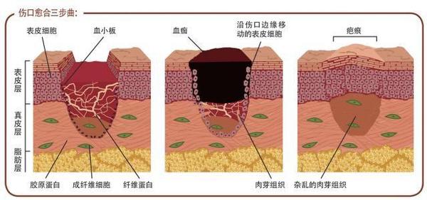 如果伤在表皮层,伤口会经过迅速再上皮化得以修复,不会留下疤痕.