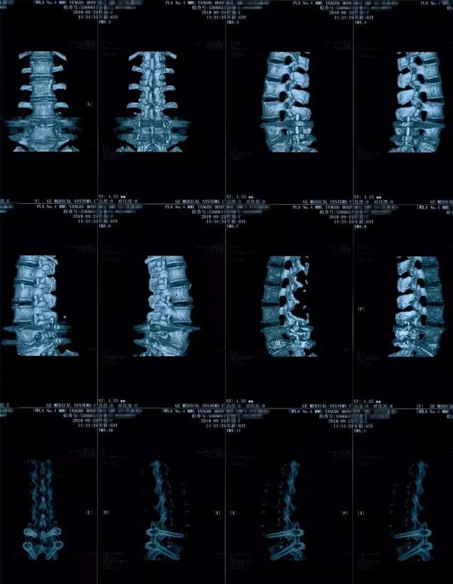 病例点评:腰椎滑脱的微创手术治疗