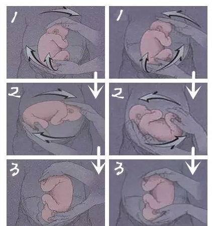 胎位扭转术,一项危险系数挺大的无创手术
