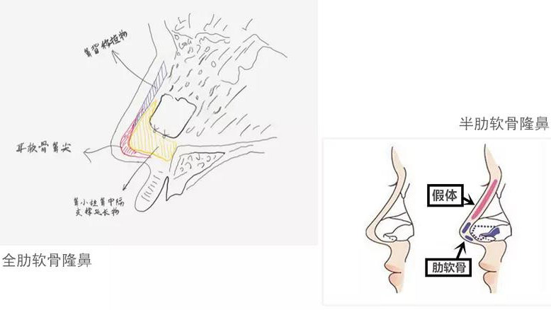 同样是肋软骨隆鼻,全肋和半肋究竟有什么区别?