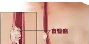7,吸烟嗜酒肯定与食管癌发病有关:烟酒越多危险性越大.