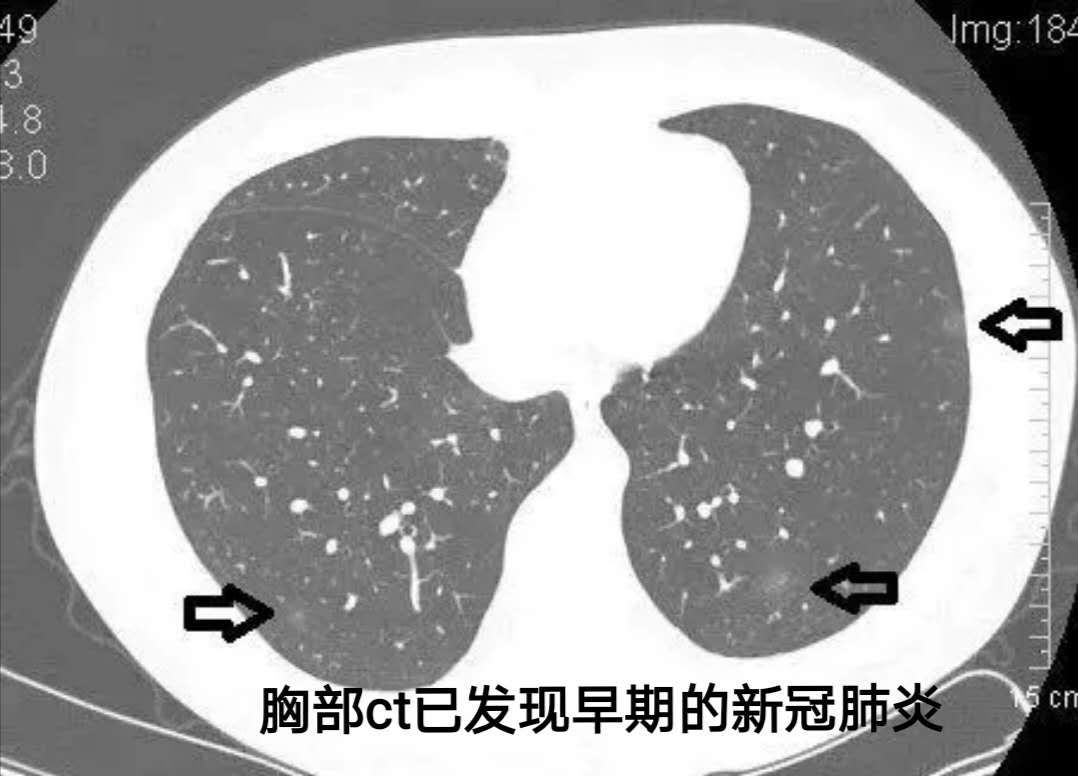 40岁以上就进入肺癌的高发期,建议40岁以上人群每年都要做个胸部ct!