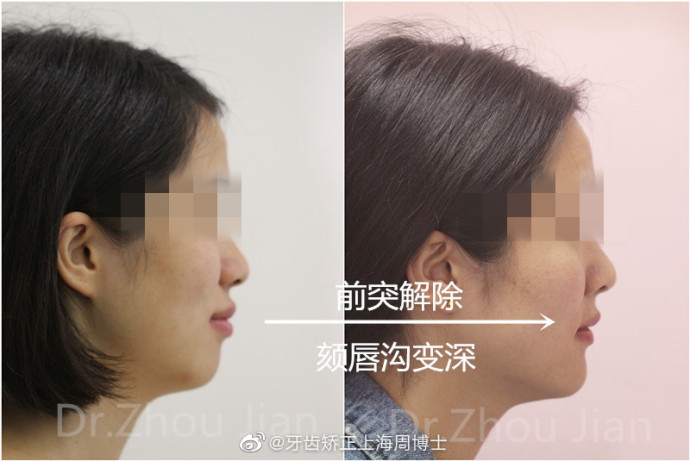 面部不美?无下巴?可能是牙齿惹的祸!