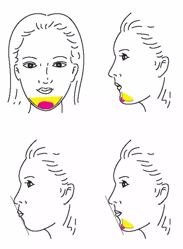 颏肌的位置位于我们下巴处,当我们作做出一些表情,比如噘嘴的时候,颏