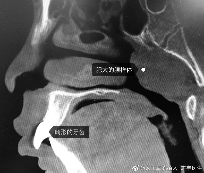 牙齿畸形的元凶竟是腺样体肥大