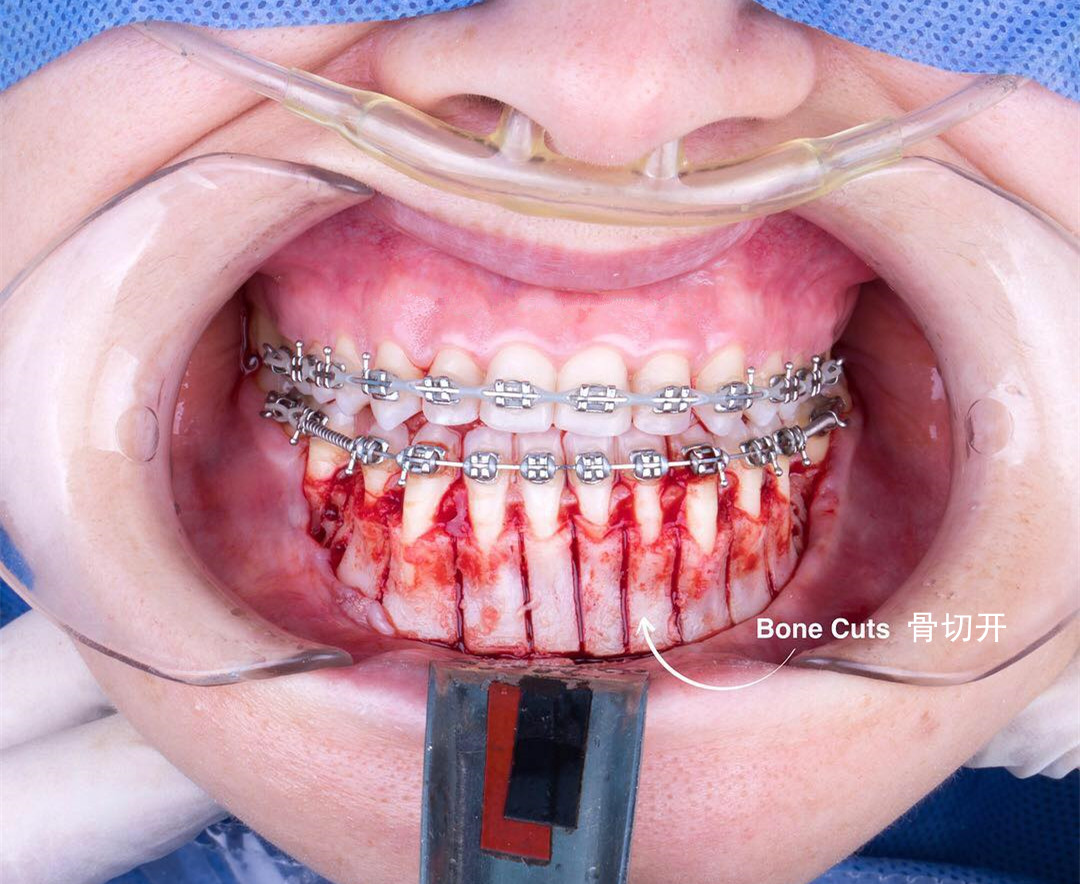 牙齿矫正有哪些加速的的方法