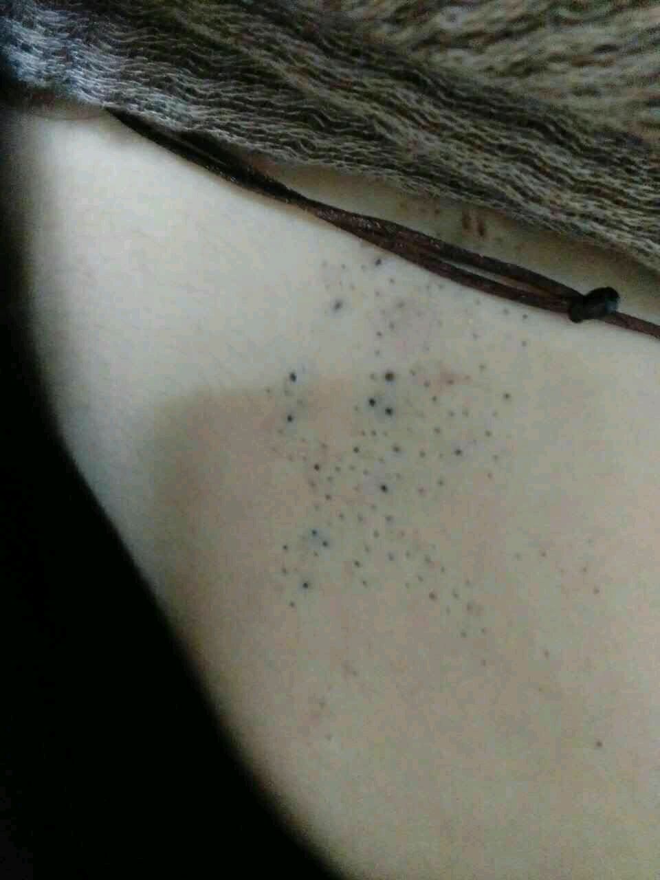 粉刺样痣