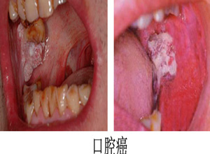 王源抽烟上了热搜吸烟对口腔的伤害你了解多少