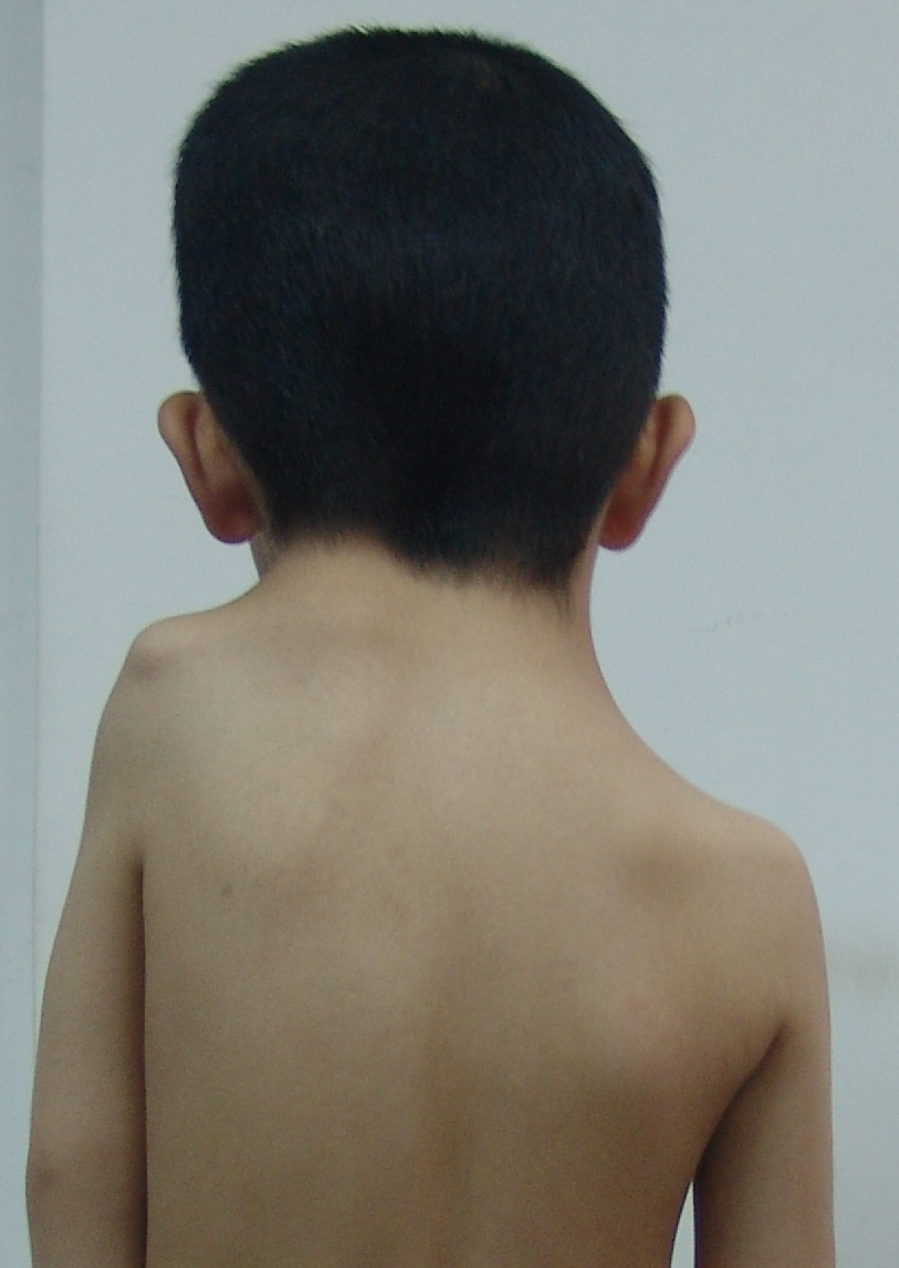 孩子肩膀一高一低,竟然不是脊柱侧弯,还有更严重的问题!