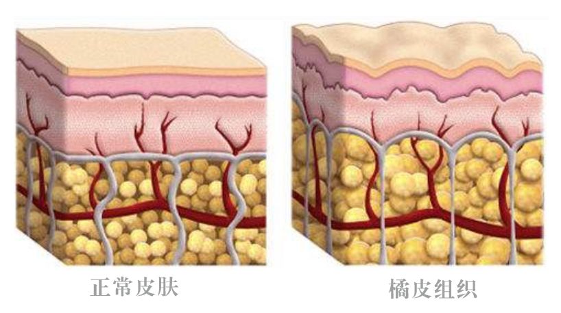 橘皮样组织是由于筋膜层的纤维束拉扯真皮真皮将脂肪挤压造成脂肪团
