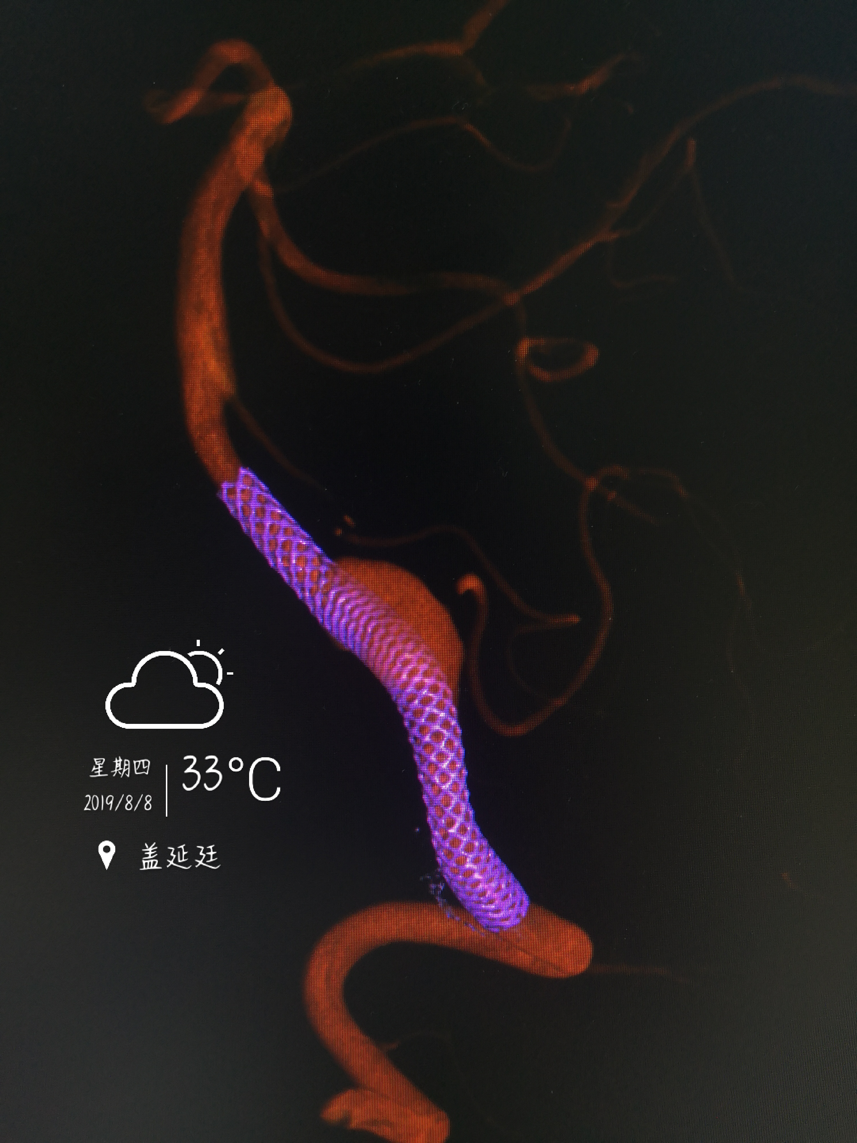 dr盖延廷‖巨大后循环椎动脉夹层动脉瘤密网支架治疗成功