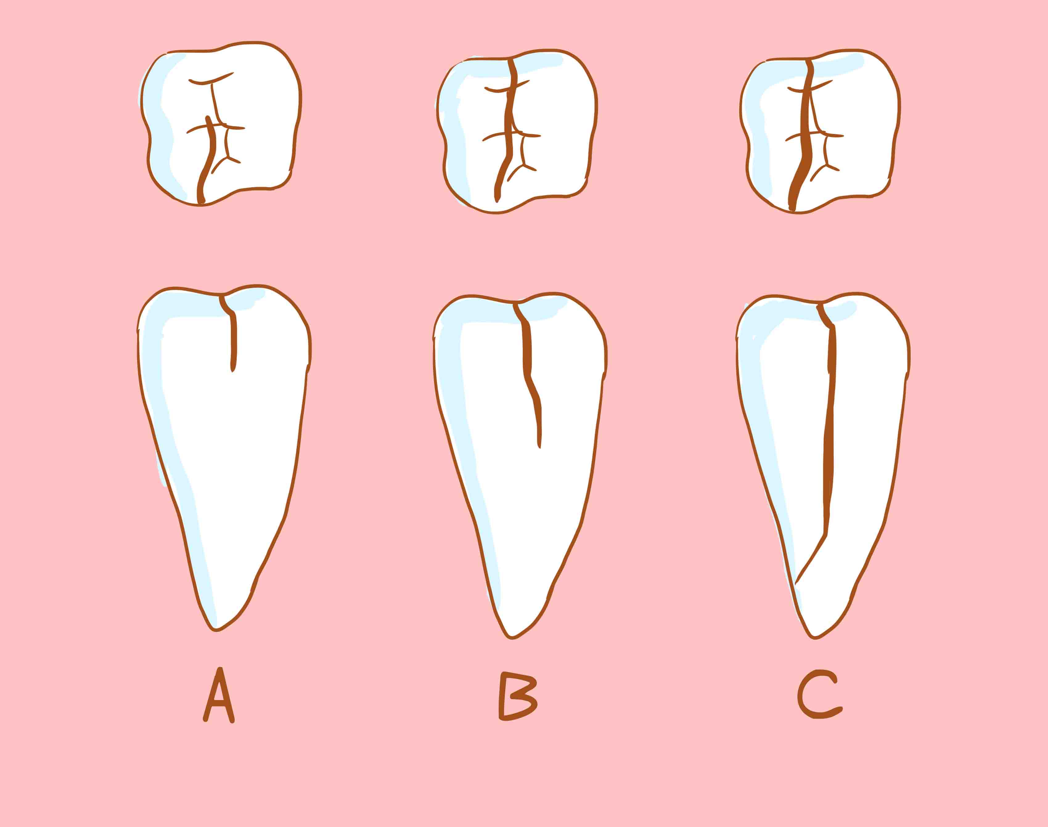 注意你的牙痛可能是牙隐裂造成的