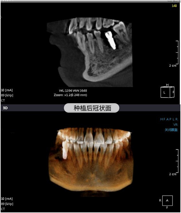 5*10 mm,旋入愈合基台.