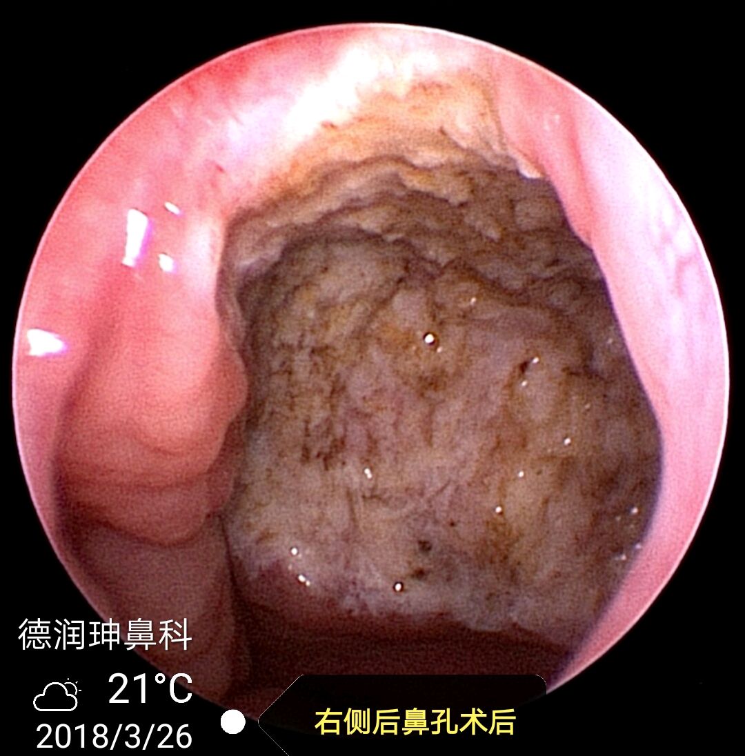 腺样体肥大患儿家长看过来之二