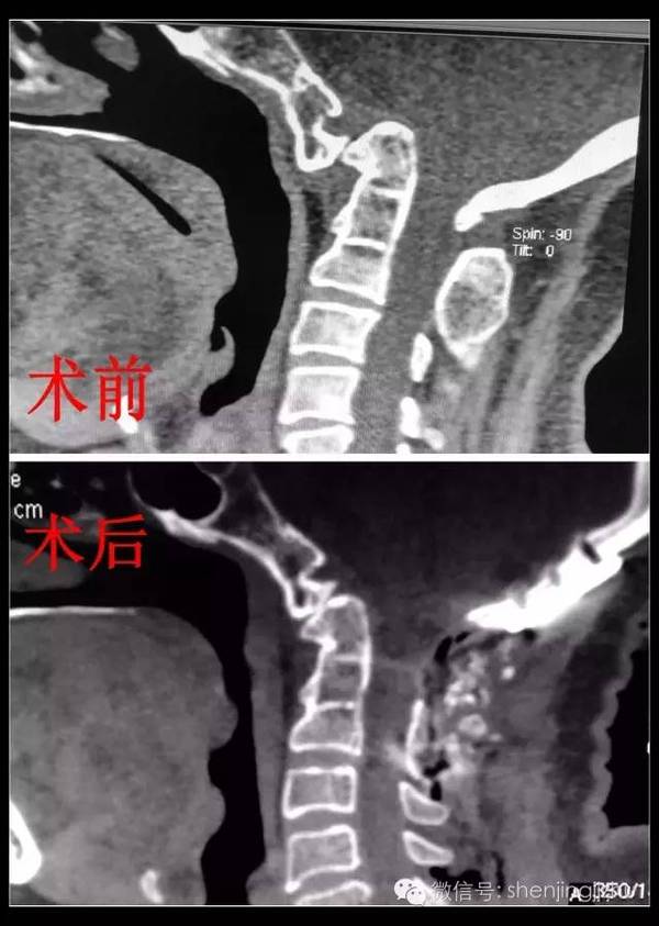 后路寰枢椎复位,枕下减压,枕颈融合术.手术方案:估计复位较困难.