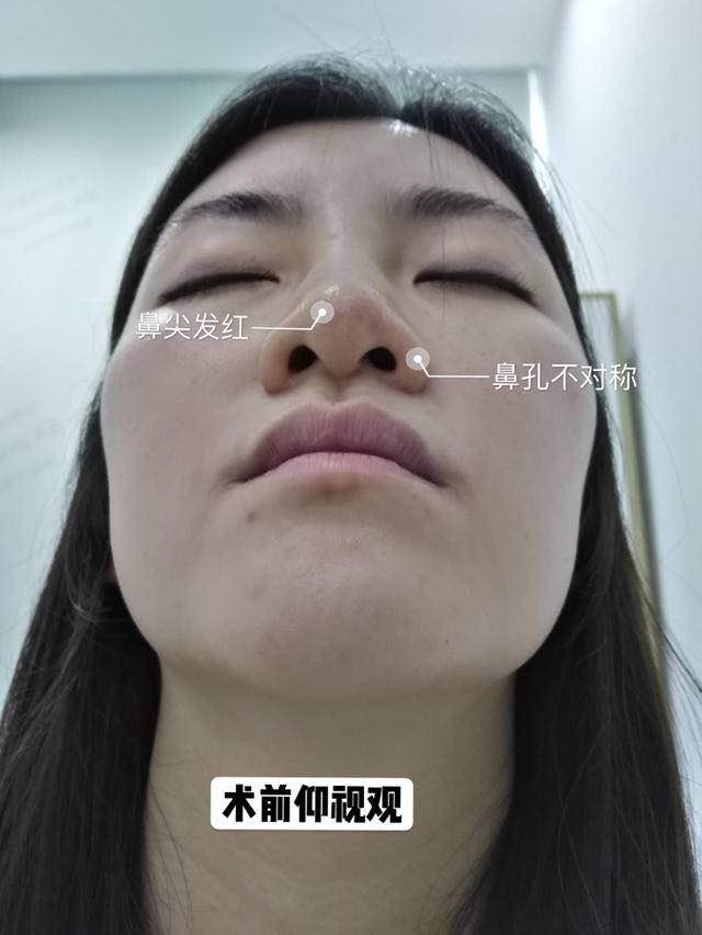 从仰视看,我们可以看到姑娘鼻孔不对称,鼻尖敏感有些泛红,整形轮廓感
