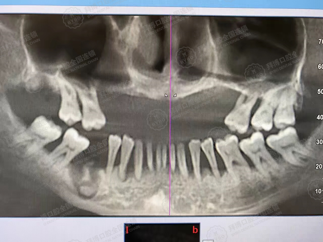 牙齿矫正该怎么区分是骨性嘴突还是牙性嘴突的？ - 知乎