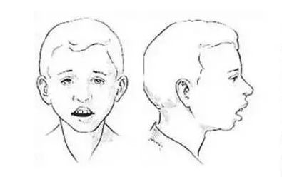 影响面容,导致驼背 口呼吸引起的呆滞面型不单单是