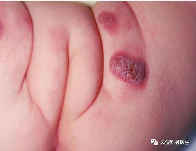 2,婴儿臀部肉芽肿(granuloma gluteale infantum)