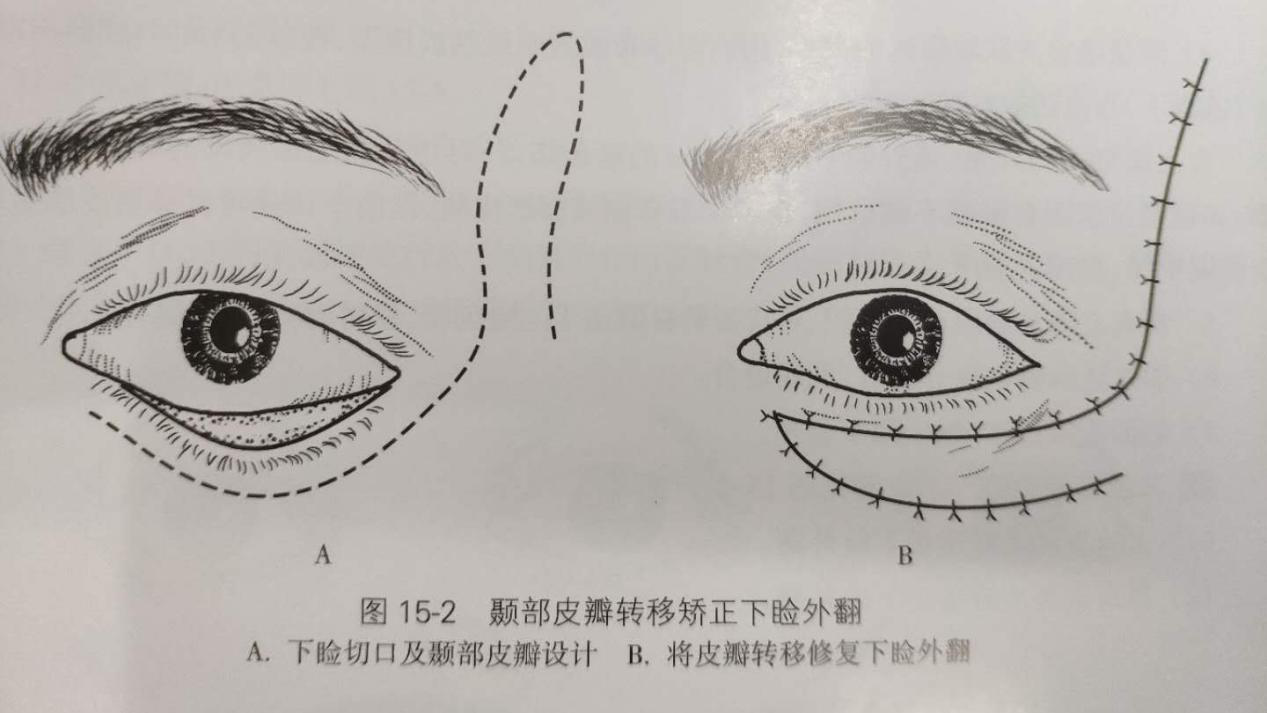 1)切除瘢痕及睑裂缝合的方法同游离皮片移植法.