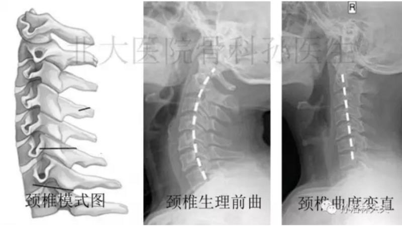 颈椎病常见问答:(五)颈椎生理曲度变直怎么办?