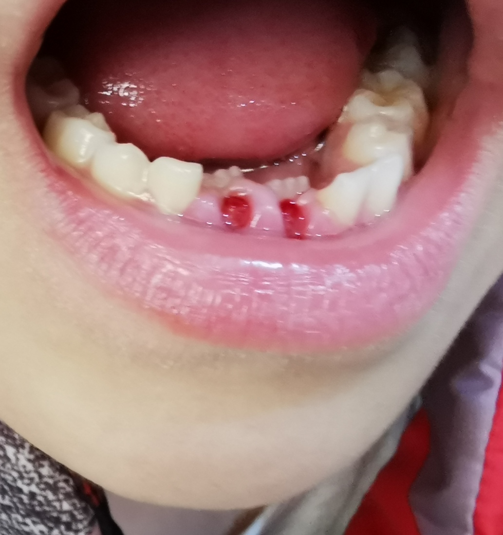牙齒不整齊要矯正嗎？4個年齡階段影響原因介紹，避免齒列問題