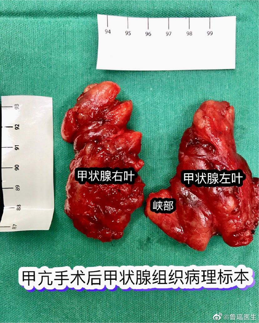 七年甲亢病史患者,最终选择手术治疗