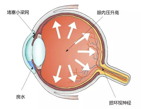 青光眼可以分为两种:开角型青光眼和闭角型青光眼.