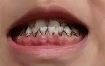 小朋友牙齿上的黑色素能去掉吗?