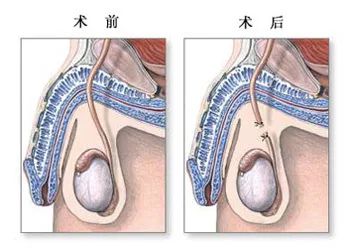 '男性结扎手术'是将成年男性阴囊中左右两条输送精子的输精管给予结扎